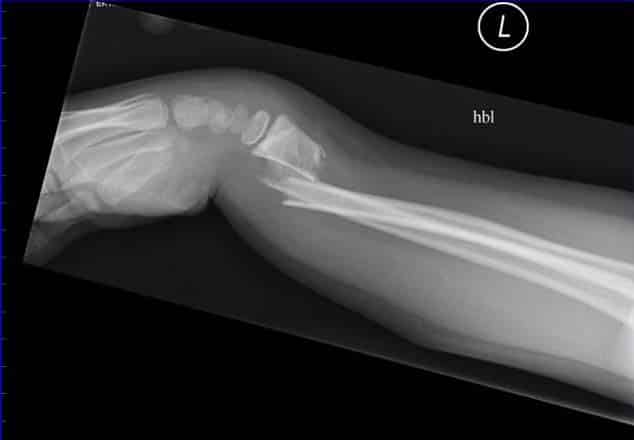 Fig 1.3 - Colles' fracture of the wrist. Note the 'dinner fork' deformity, produced by the posterior displacement of the radius.