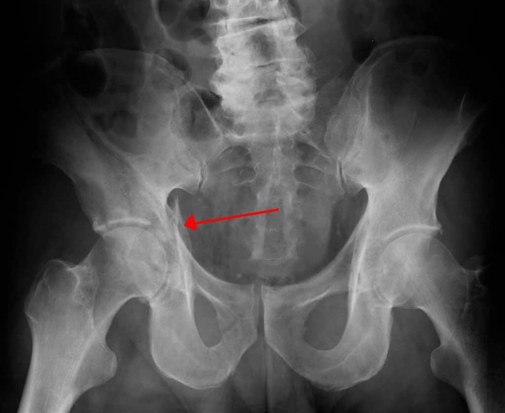 xray of a normal right hip