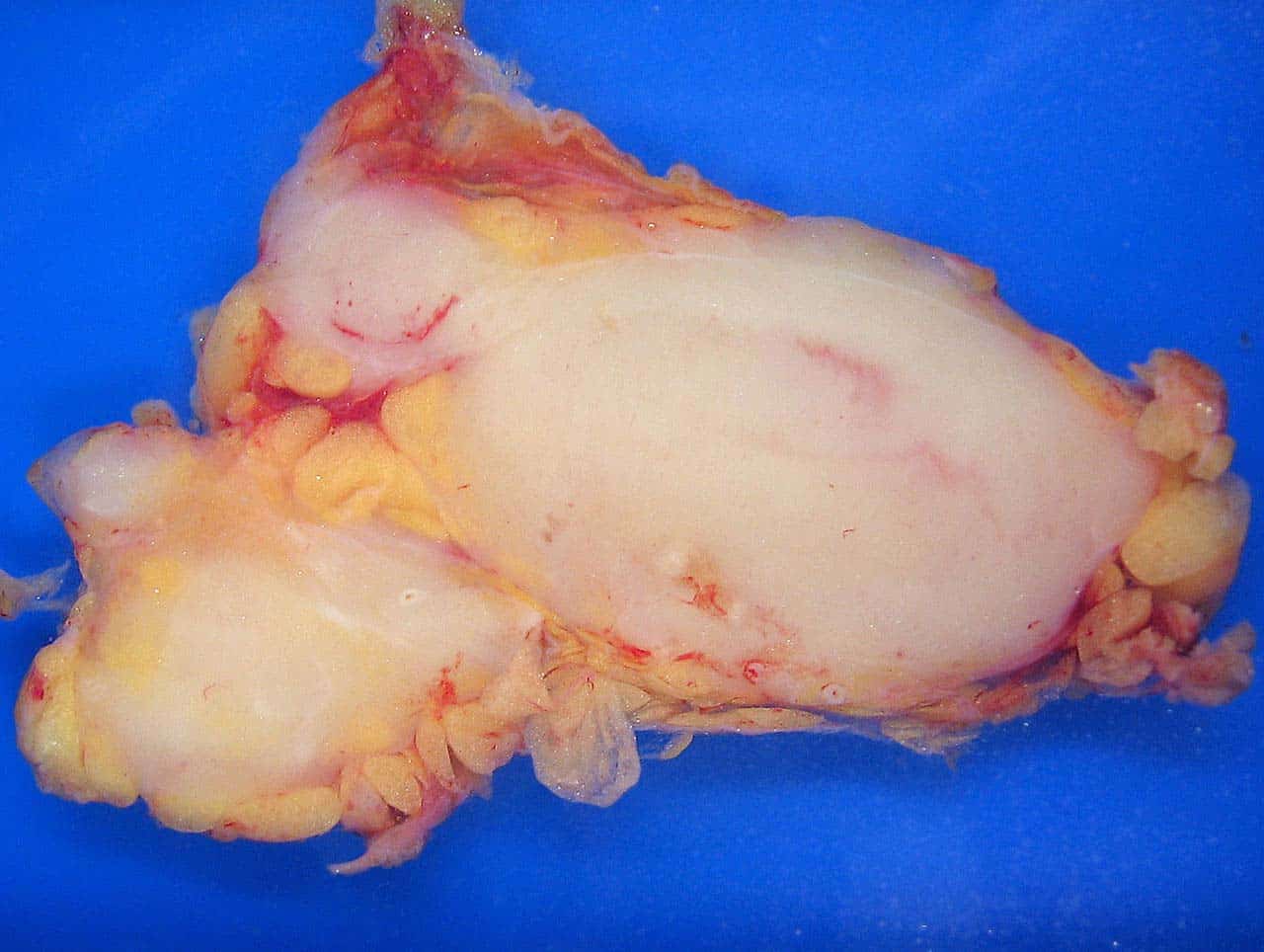 Fig 4 - A follicular lymphoma.
