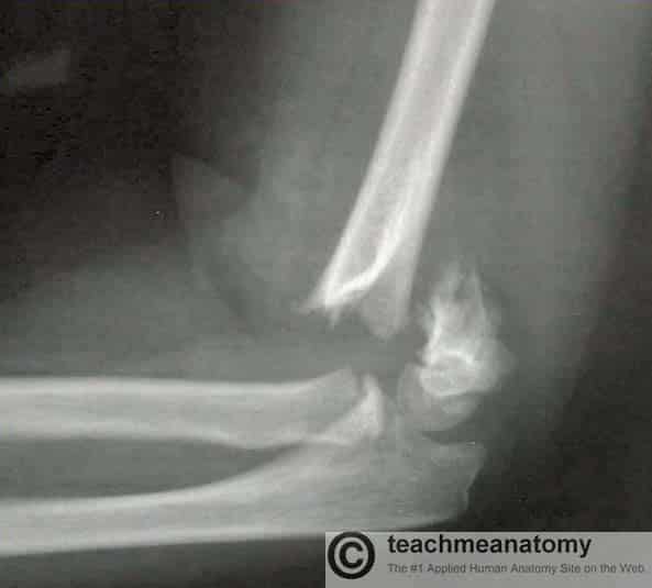 Radiografía que muestra una fractura supracondílea del húmero.