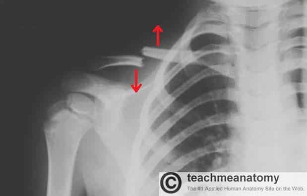 Radiografía en la que se observa una fractura de clavícula con el extremo medial elevado y el extremo lateral descendido.